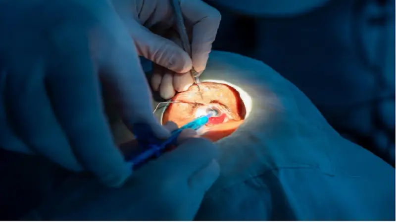 What Activities Should You Avoid After Cataract Surgery?